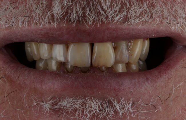 After (Teeth)