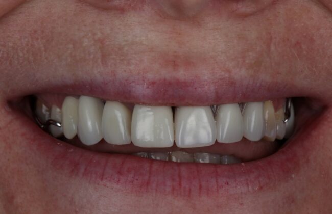 After