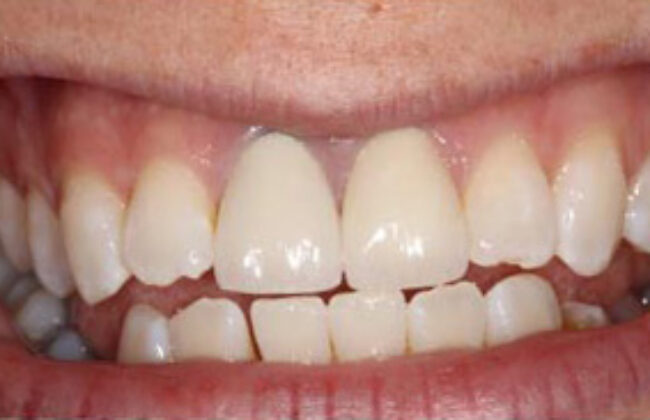 Before (Teeth)