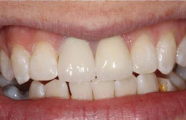 After (Teeth)