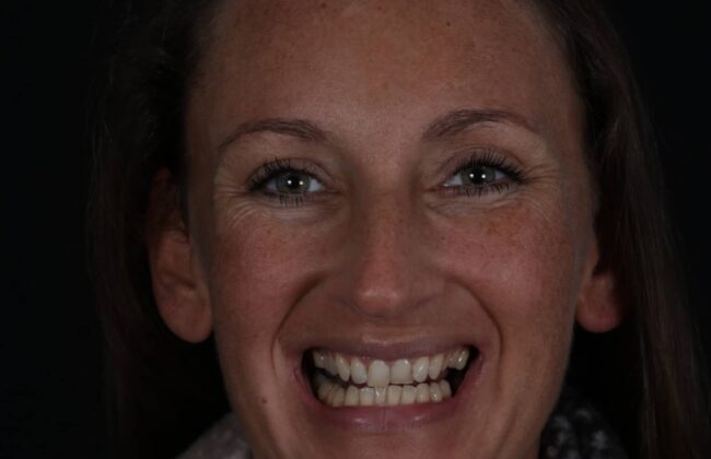 Before (Teeth)