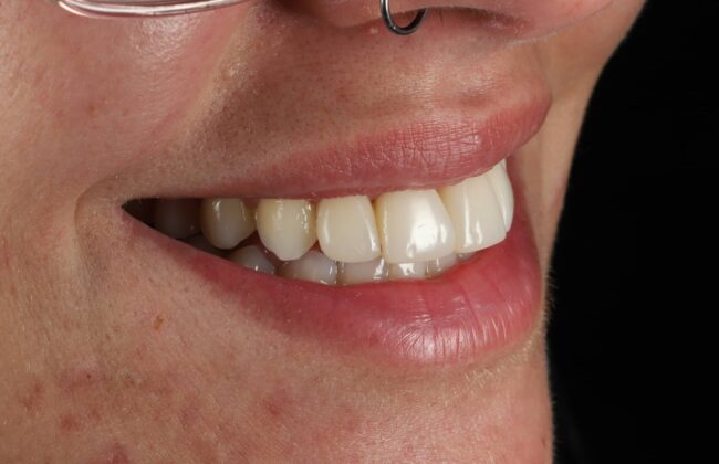After (Teeth)