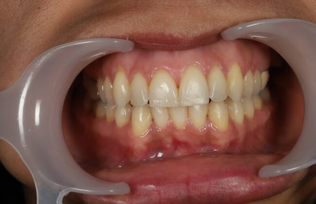 After (Teeth)