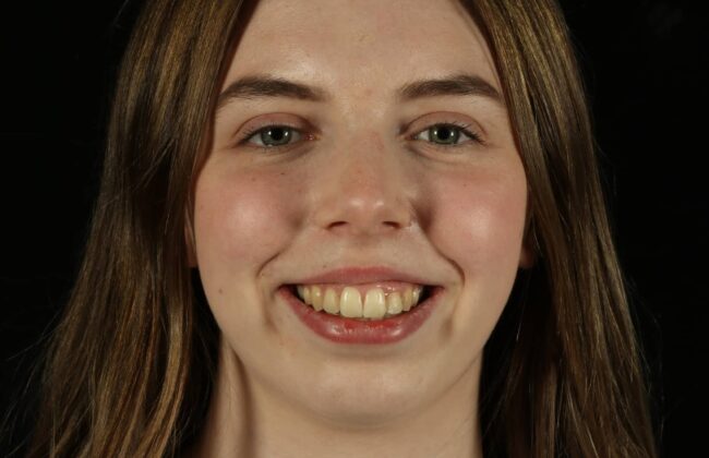 After (Teeth)