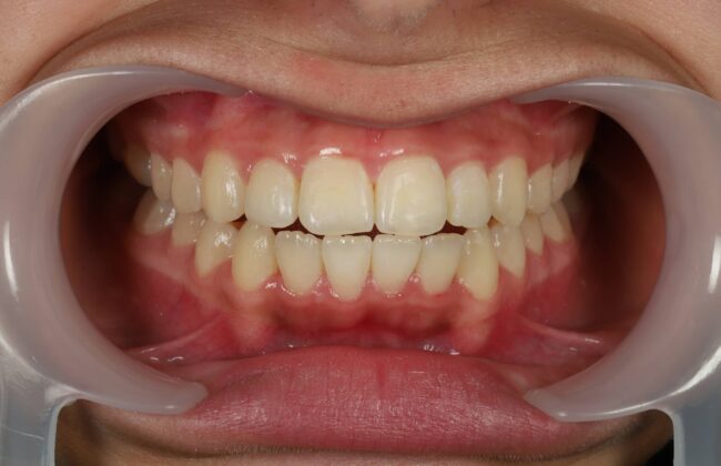 After (Teeth)