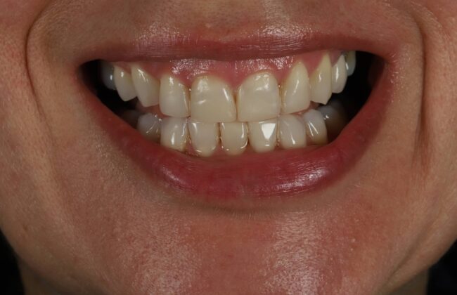After (Teeth)