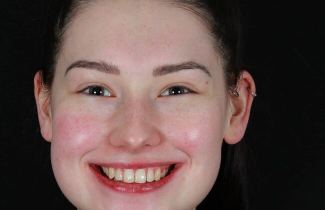 Before (Teeth)