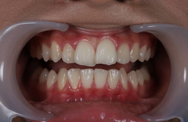 Before (Teeth)