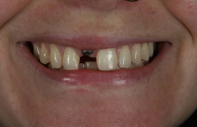 Before