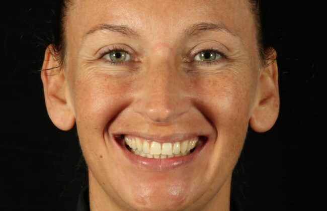 After (Teeth)