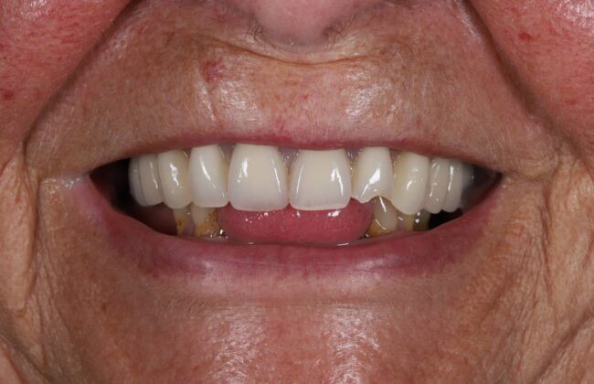 Before (Teeth)