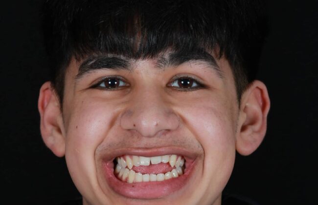 Before (Teeth)