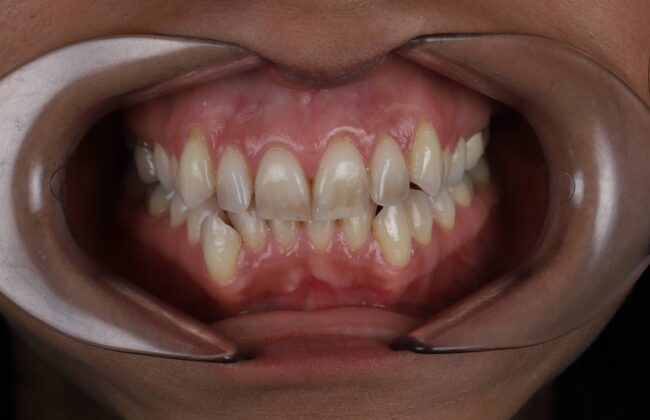 Before (Teeth)