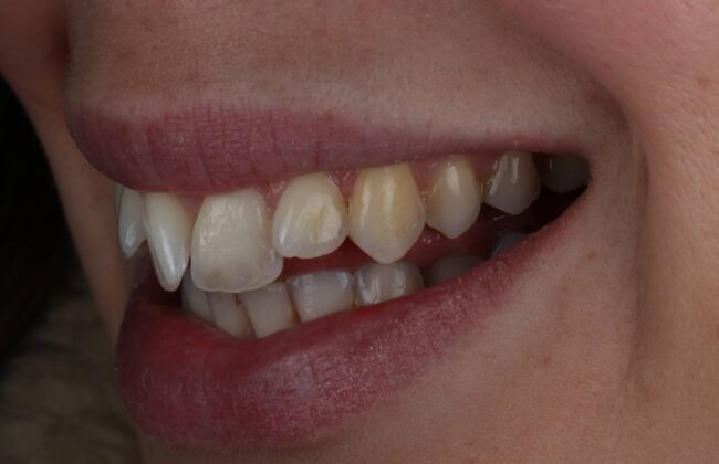 Before (Teeth)