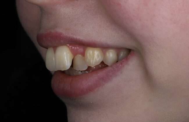 Before (Teeth)