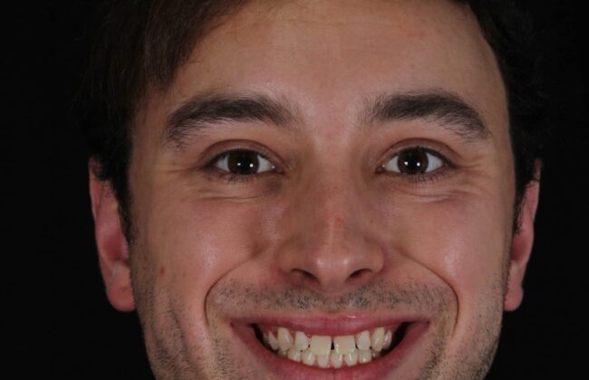 Before (Teeth)