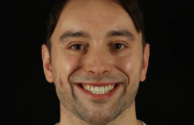 After (Teeth)