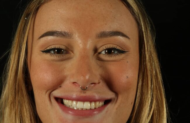 After (Teeth)