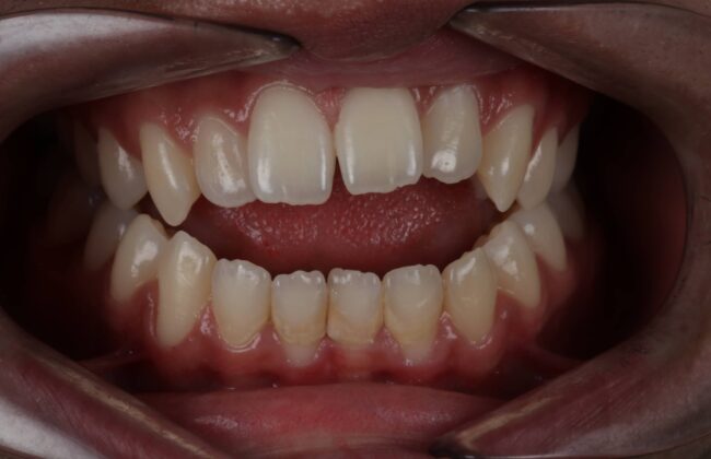 Before (Teeth)