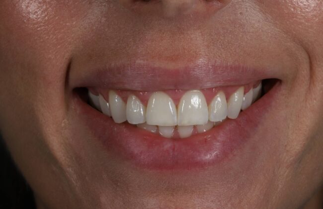 After (Teeth)