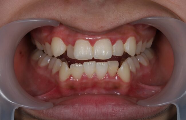 Before (Teeth)