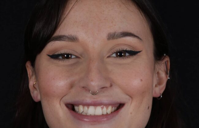 Before (Teeth)