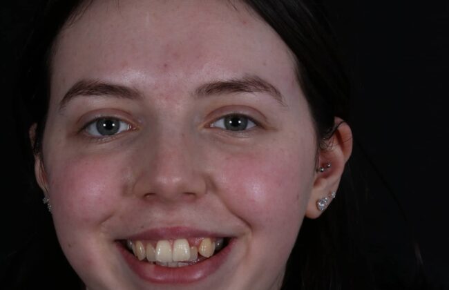 Before (Teeth)