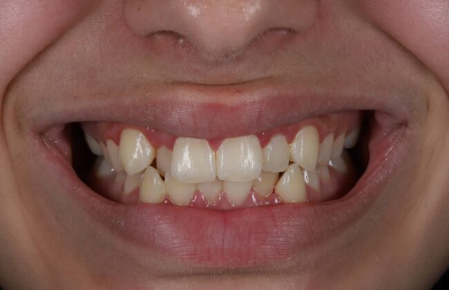 Before