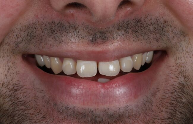 Before