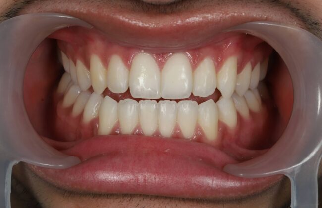 After (Teeth)