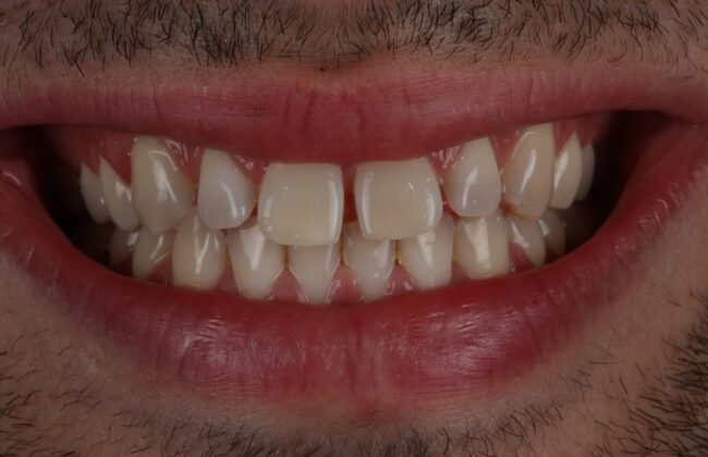 Before