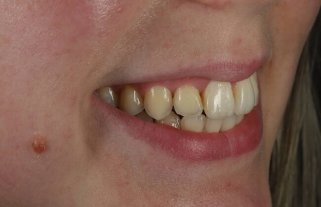 After (Teeth)