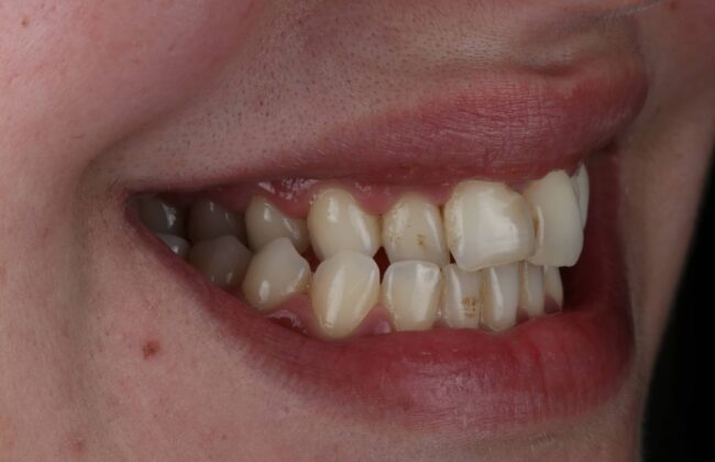Before (Teeth)