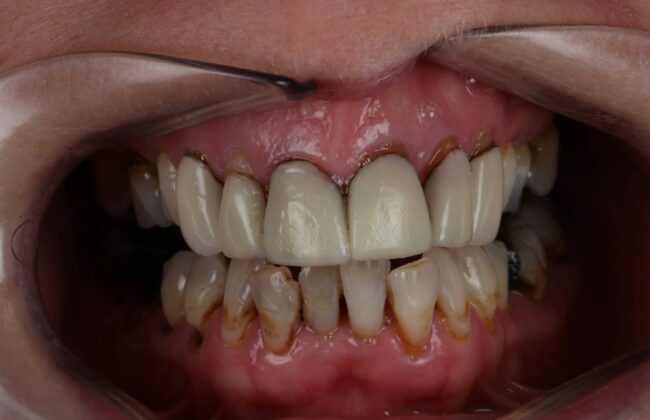 Before (Teeth)