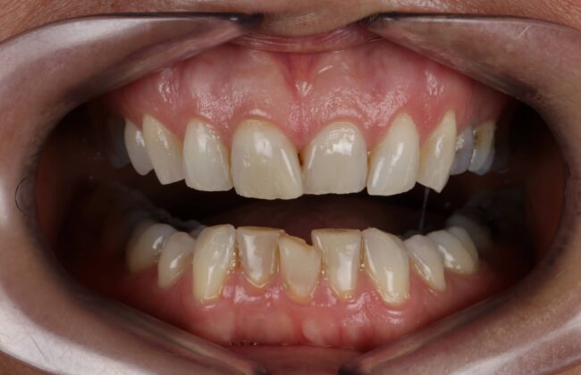 Before (Teeth)