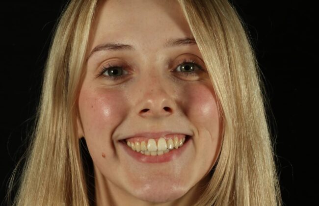 After (Teeth)