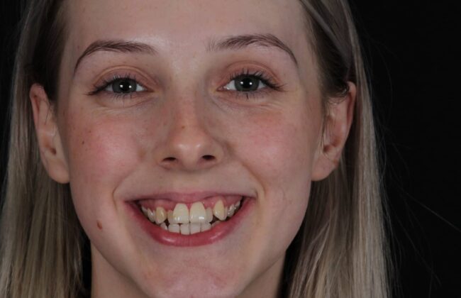 Before (Teeth)