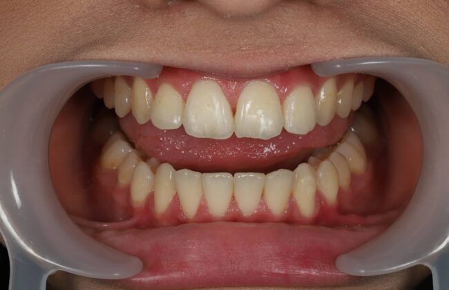 After (Teeth)