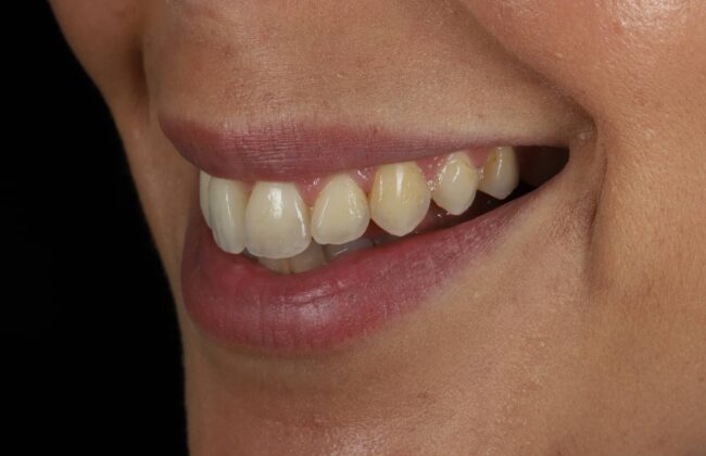 After (Teeth)