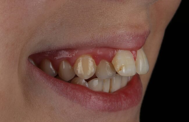Before (Teeth)
