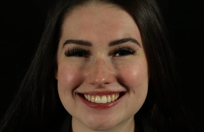 After (Teeth)