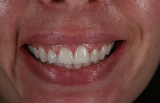 Before (Teeth)