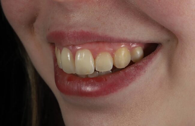 After (Teeth)