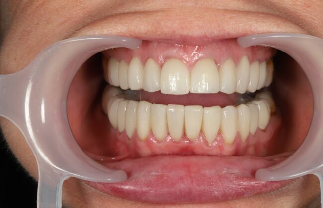 After (Teeth)