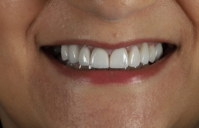 After (Teeth)