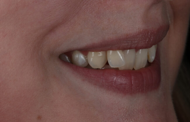 Before (Teeth)