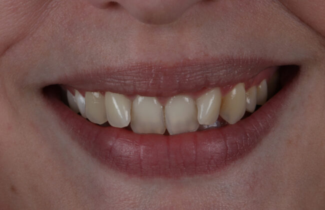 Before (Teeth)