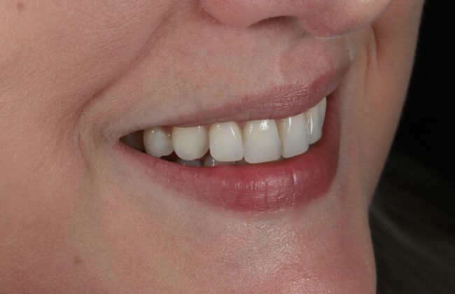 After (Teeth)