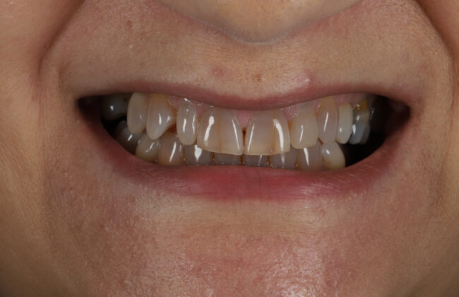 Before (Teeth)