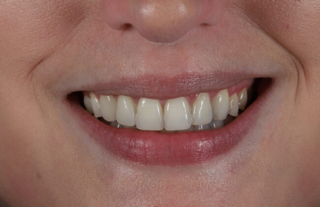 After (Teeth)